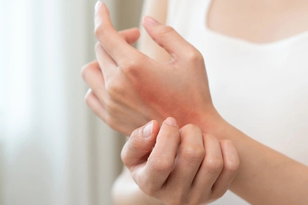 Podrażnione i zaczerwienione ręce